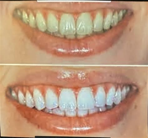 teeth whitening lodi